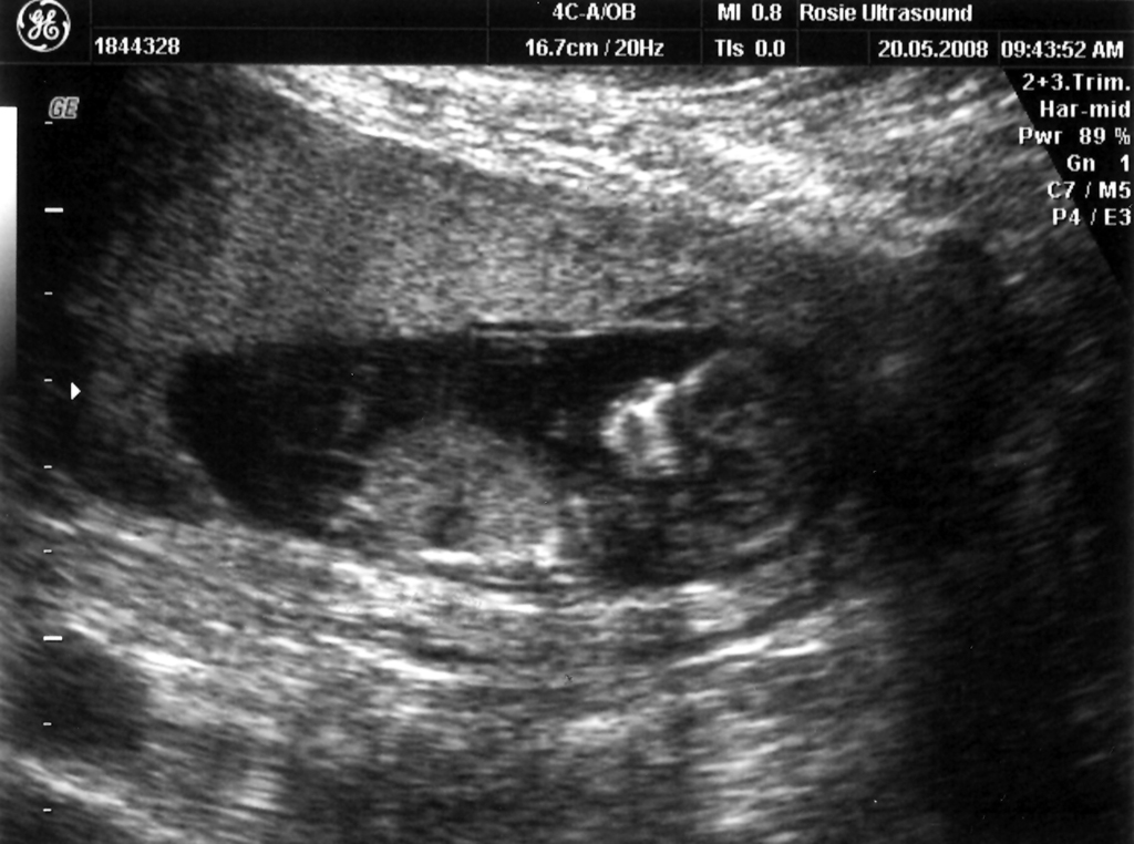 The Peanut at 12 weeks